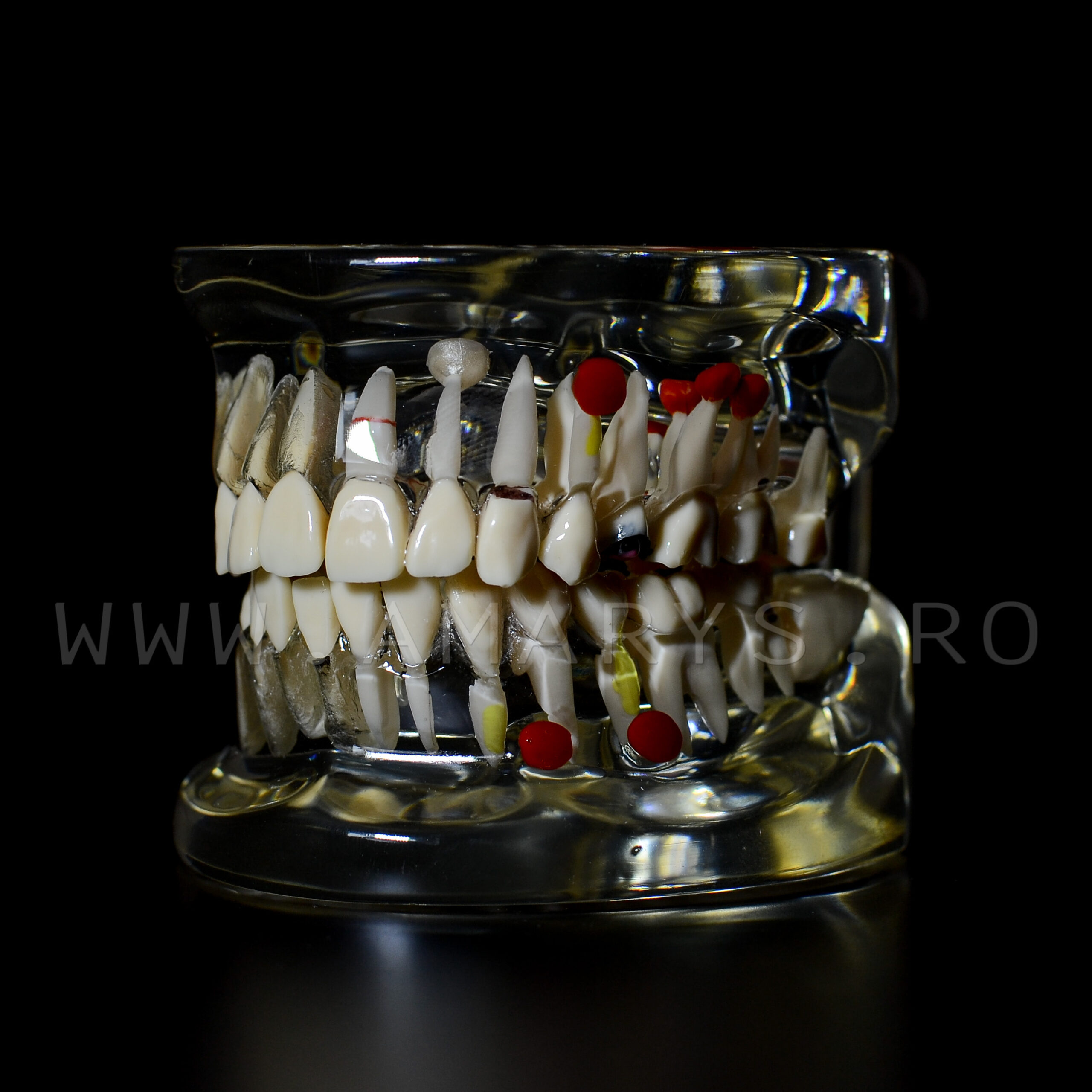 Arcada dentara  dinti detasabili + patologie molar inclus - cariologie - bont protetic