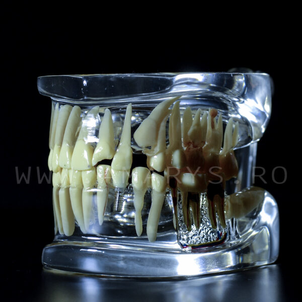 Arcada dentara patologie implant - canin inclus- vascularizatie