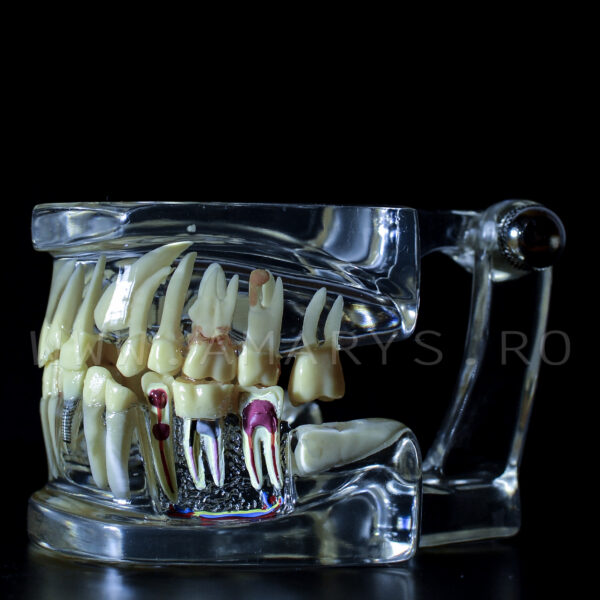 Arcada dentara patologie implant - canin inclus- vascularizatie