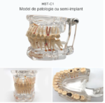 Arcada dentara patologie implant - endo - cario