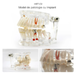 Arcada dentara patologie implant - molar inclus - extruzie