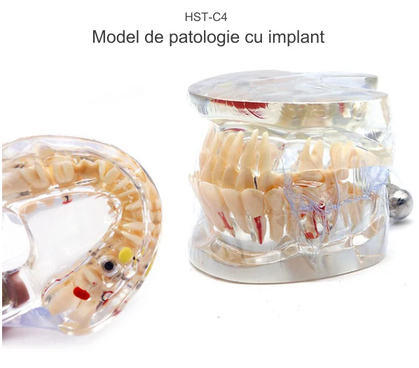 Arcada dentara demonstrativa cu patologie si implant