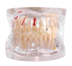 Arcada dentara demonstrativa cu patologie si implant