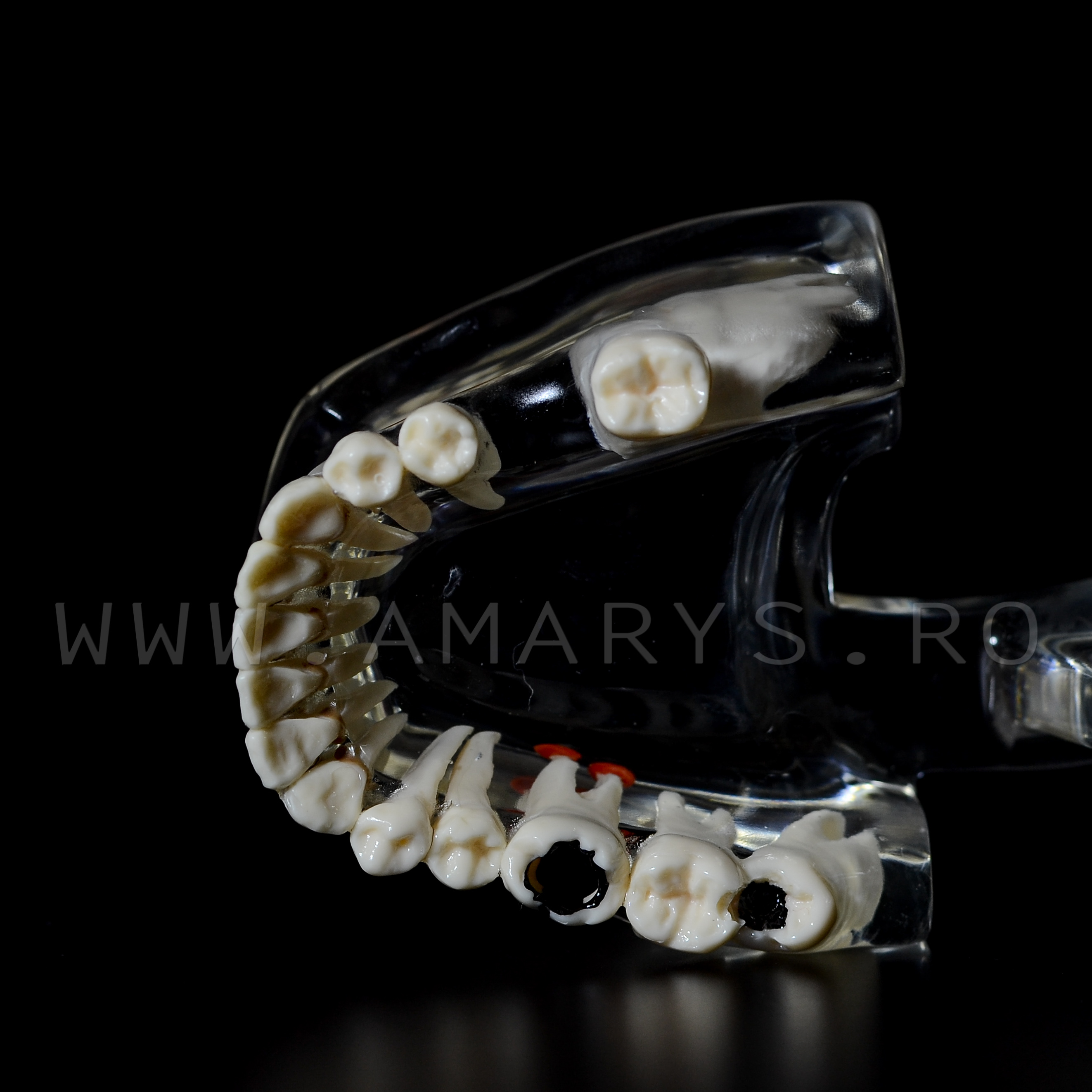 Arcada dentara patologie implant - molar inclus - extruzie