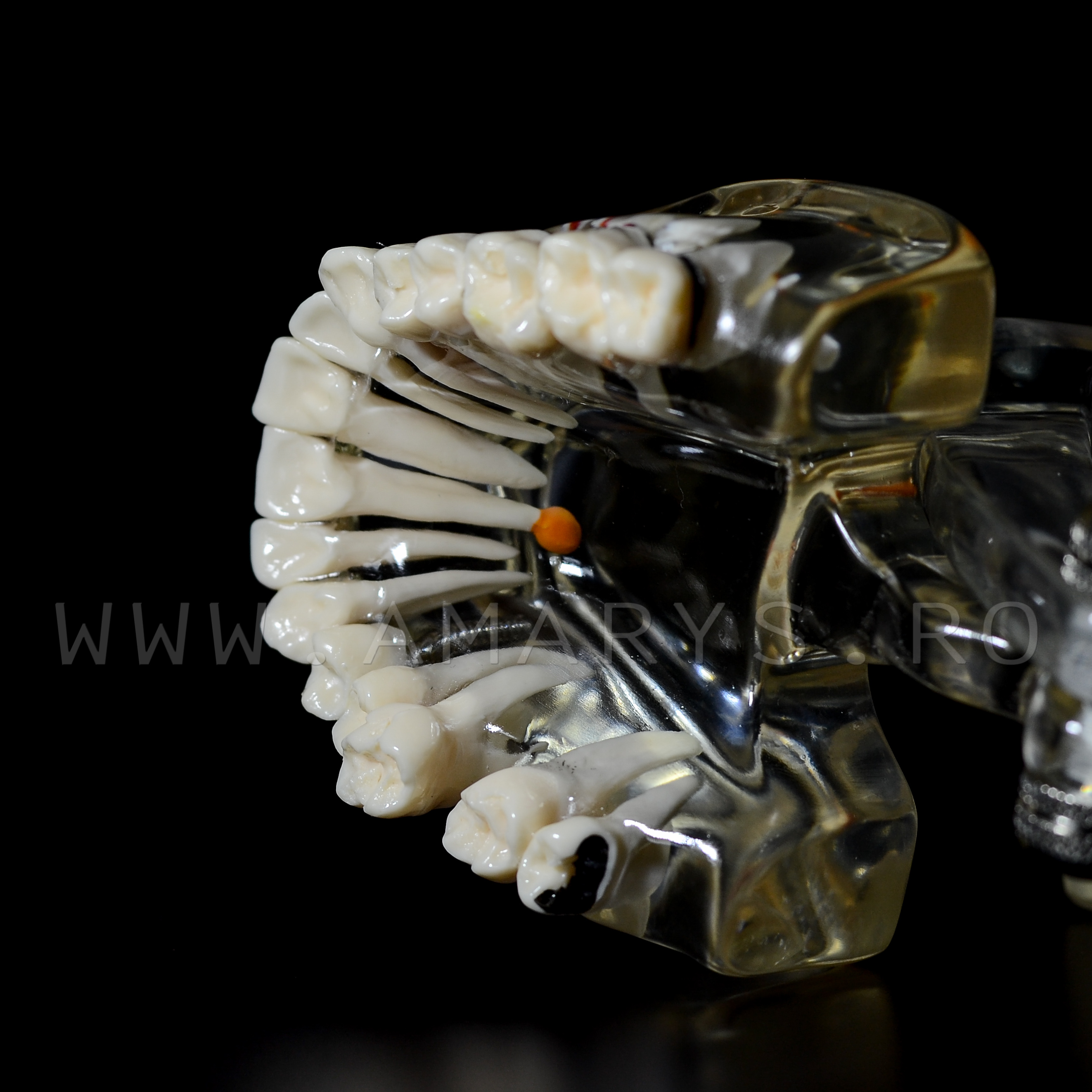 Arcada dentara patologie implant - molar inclus - extruzie