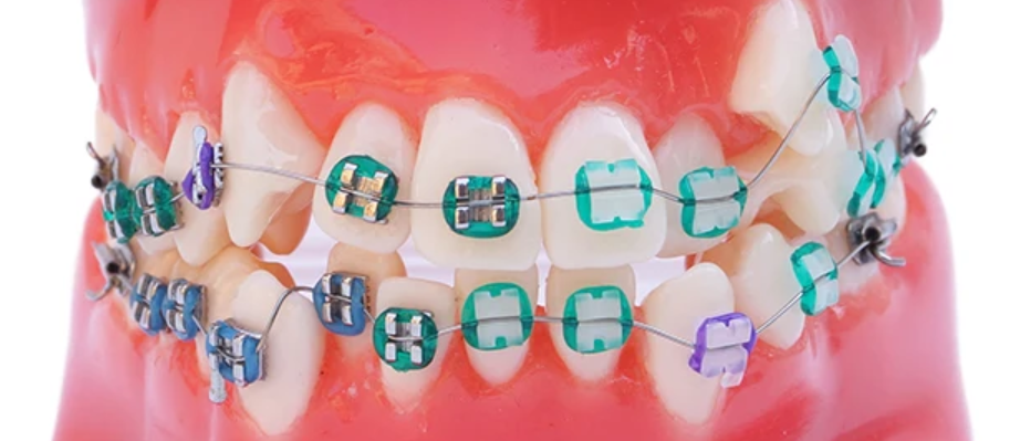 Arcada dentara ortodontie metalo-ceramic B4-02