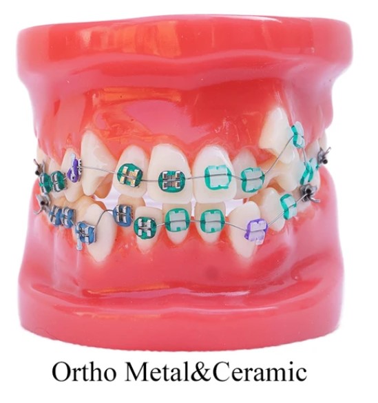 Arcada dentara ortodontie metalo-ceramic B4-02