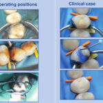 Kit Matrici Metalice Sectionale Conturate ASORTATE TOR VM 100buc/Kit