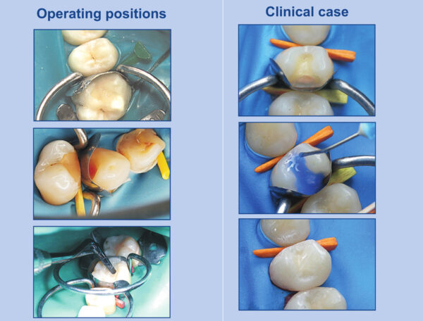 Kit Matrici Metalice Sectionale Conturate ASORTATE TOR VM 100buc/Kit