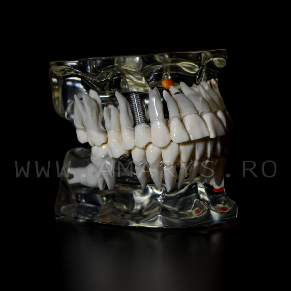 Arcada dentara patologie implant - molar inclus - extruzie