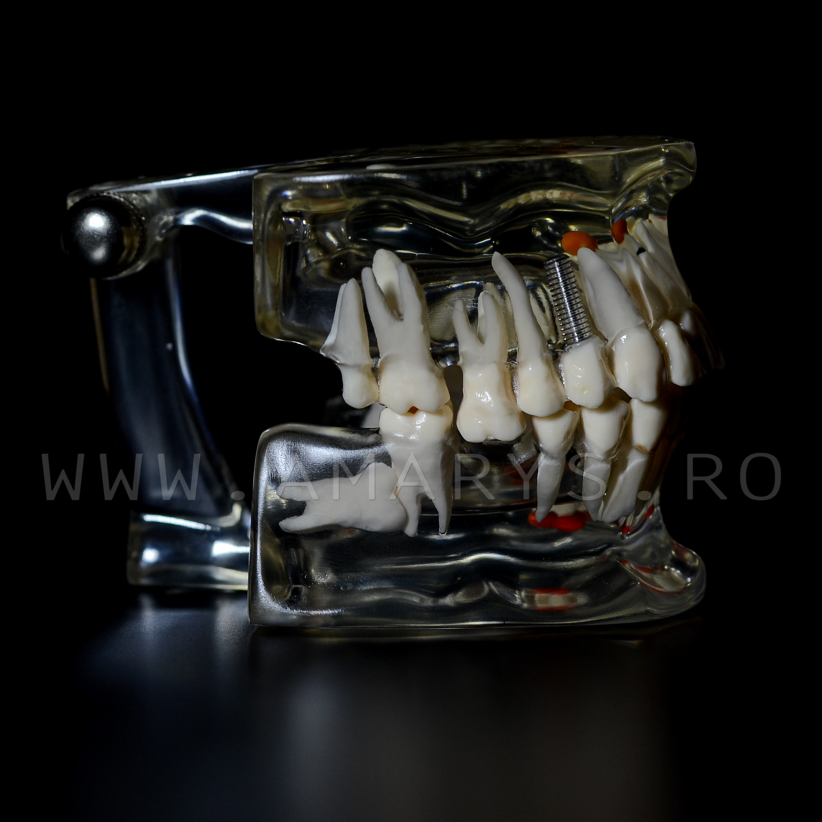 Arcada dentara patologie implant - molar inclus - extruzie