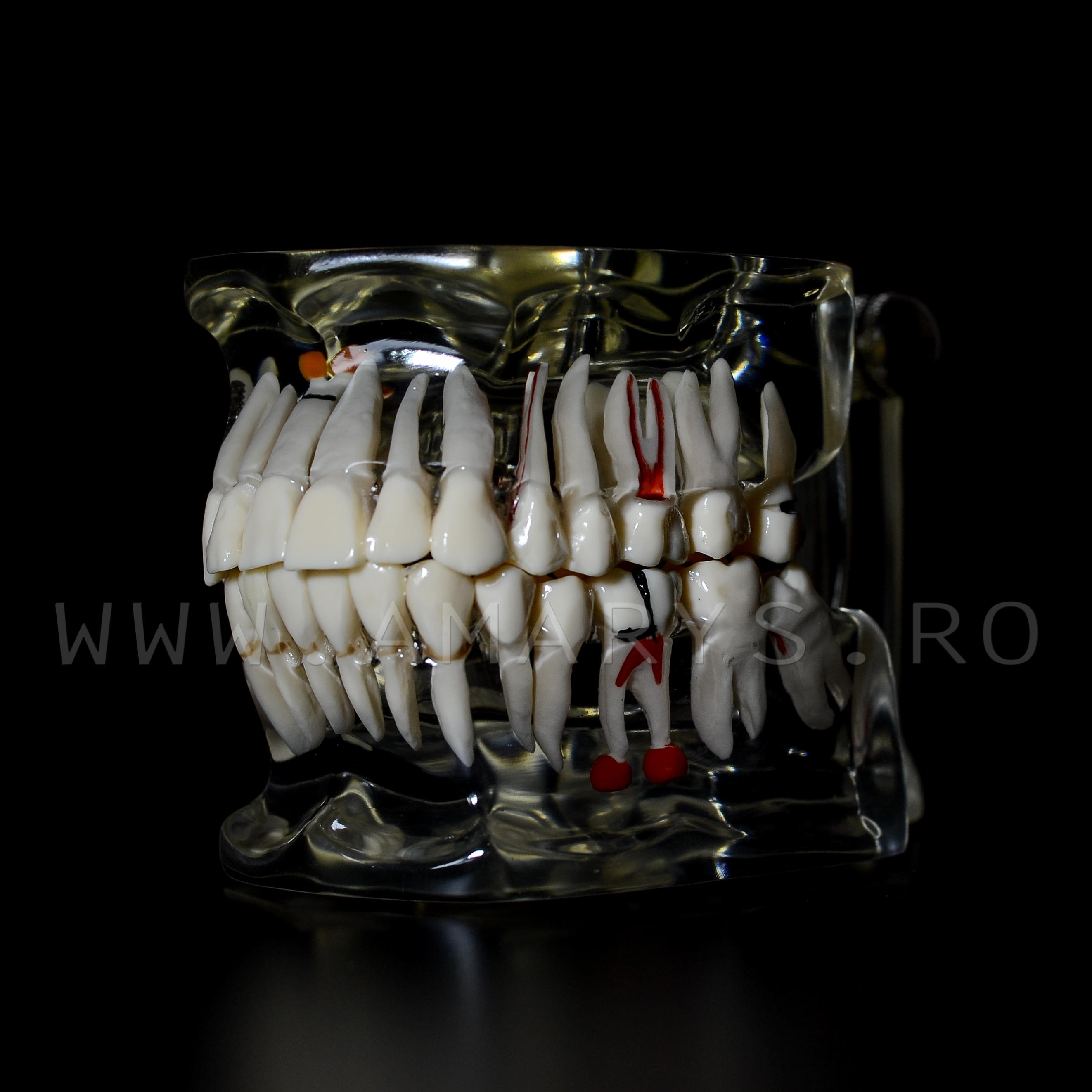 Arcada dentara patologie implant - molar inclus - extruzie
