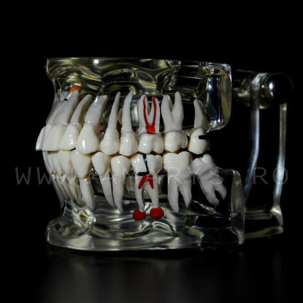 Arcada dentara patologie implant - molar inclus - extruzie