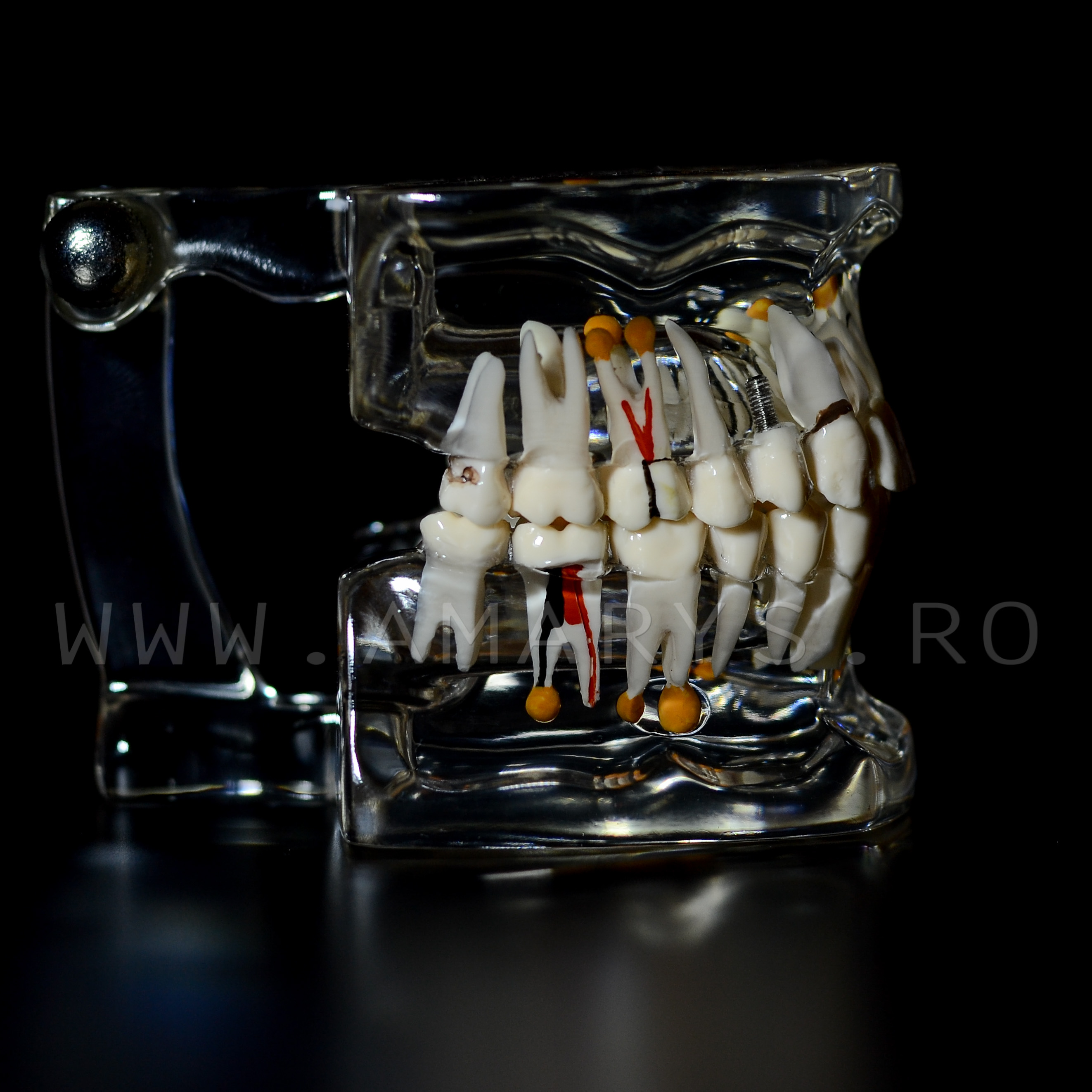 Arcada dentara patologie implant - endo - cario