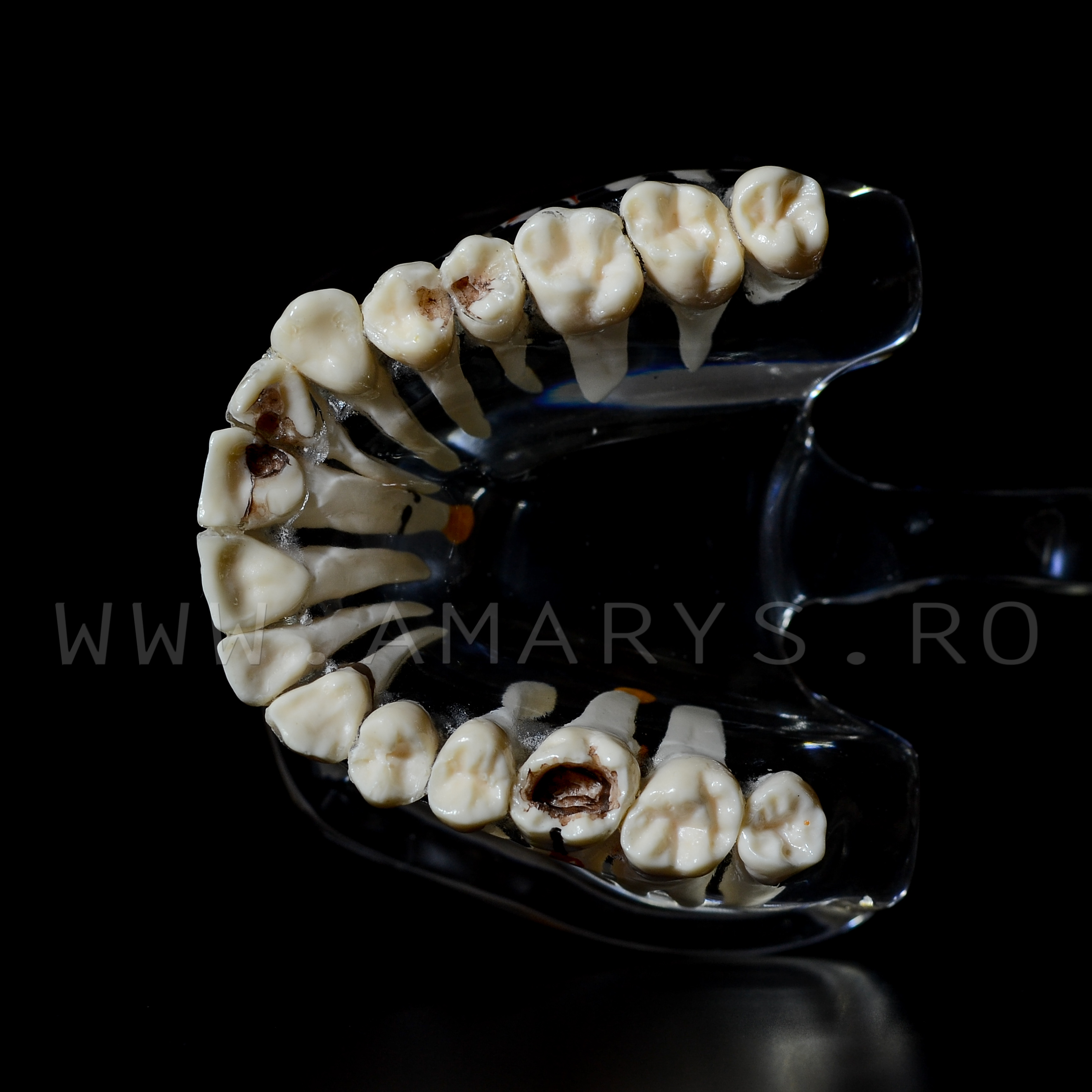 Arcada dentara patologie implant - endo - cario