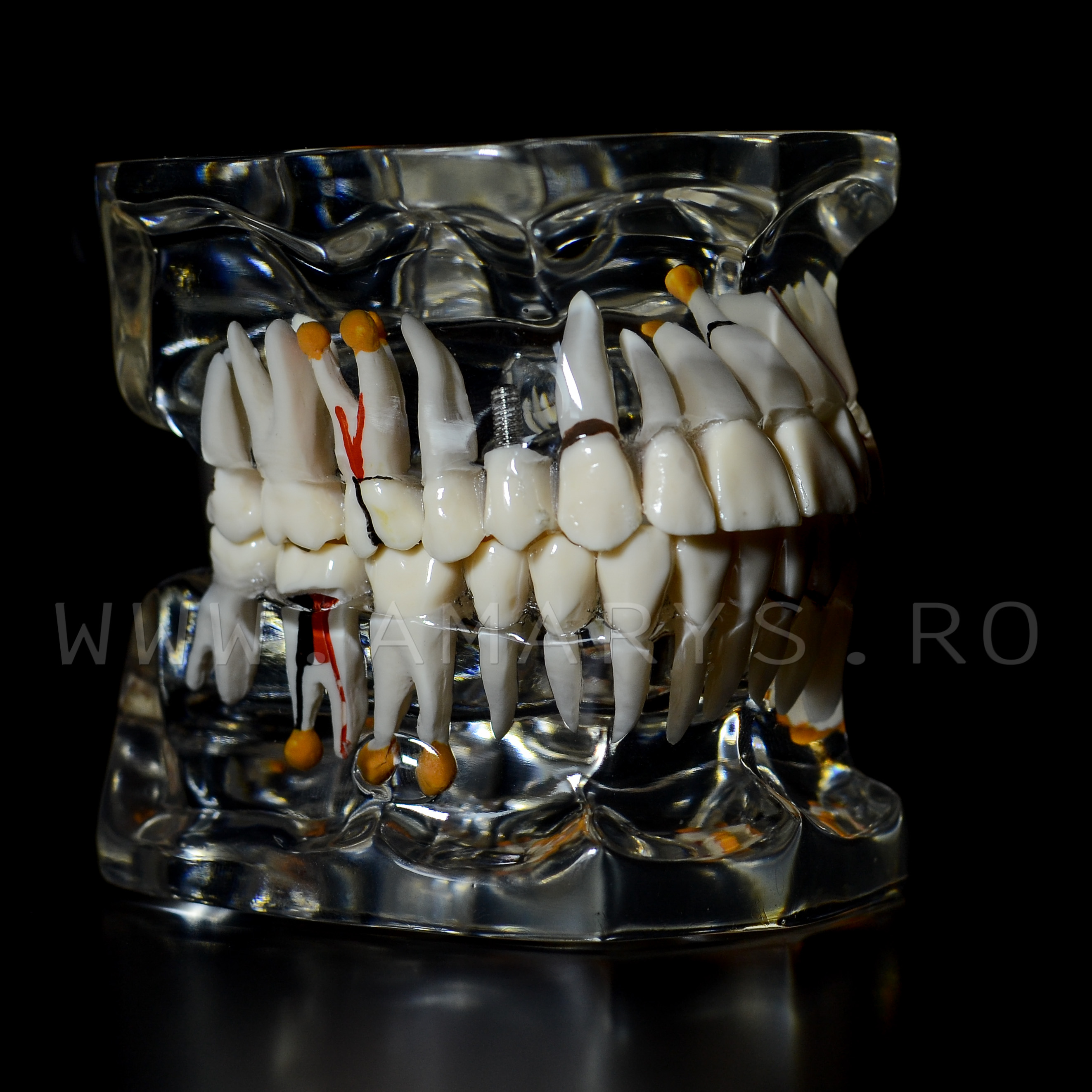 Arcada dentara patologie implant - endo - cario