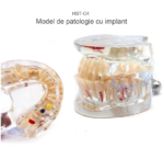 Arcada dentara demonstrativa cu patologie si implant