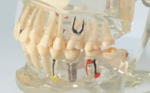 Arcada dentara demonstrativa cu patologie si implant