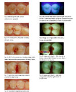 Detector carie cu UV