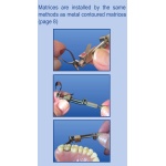 Matrice Metalica tip Banda Molari -12buc/set