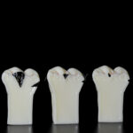 Model 3 dinti mariti cu evolutie carioasa Clasa 1 si 5 Black +endo