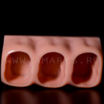 Model 3 dinti mariti cu evolutie carioasa Clasa 1 si 5 Black +endo