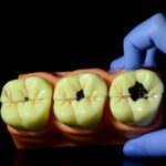 Model 3 dinti mariti cu evolutie carioasa Clasa 1 si 5 Black +endo