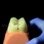 Model 3 dinti mariti cu evolutie carioasa Clasa 1 si 5 Black +endo