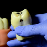 Model 3 dinti mariti cu evolutie carioasa Clasa 1 si 5 Black +endo