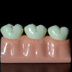 Model 3 dinti mariti cu evolutie carioasa Clasa 1 si 5 Black +endo