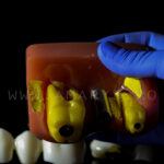 Model explicativ marit cu Implant+ Bont protetic +Coroana pe implant vs Lucrare dentara