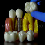 Model explicativ marit cu Implant+ Bont protetic +Coroana pe implant vs Lucrare dentara