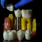 Model explicativ marit cu Implant+ Bont protetic +Coroana pe implant vs Lucrare dentara