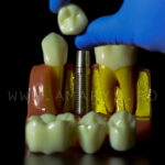 Model explicativ marit cu Implant+ Bont protetic +Coroana pe implant vs Lucrare dentara