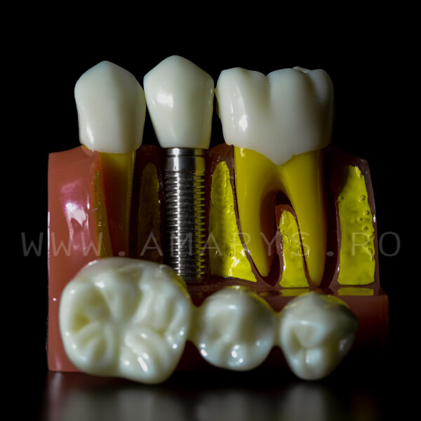 Model explicativ marit cu Implant+ Bont protetic +Coroana pe implant vs Lucrare dentara