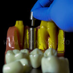 Model explicativ marit cu Implant+ Bont protetic +Coroana pe implant vs Lucrare dentara
