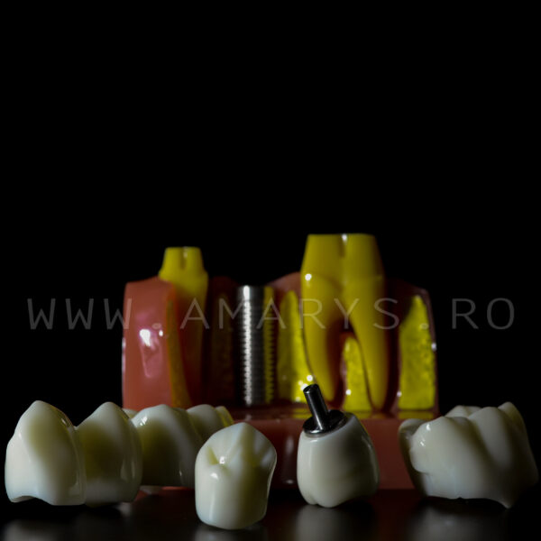 Model explicativ marit cu Implant+ Bont protetic +Coroana pe implant vs Lucrare dentara